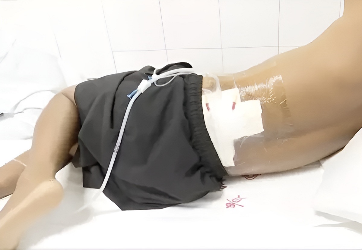 اصابت آذرخش به مرد چینی- لیو نان بر روی تخت بیمارستان