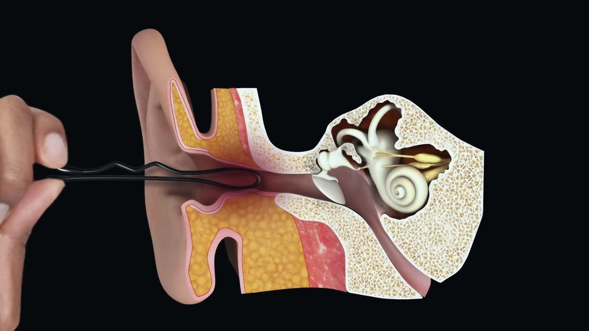 دلایل تیر کشیدن گوش-فرو کردن اجسام داخل گوش