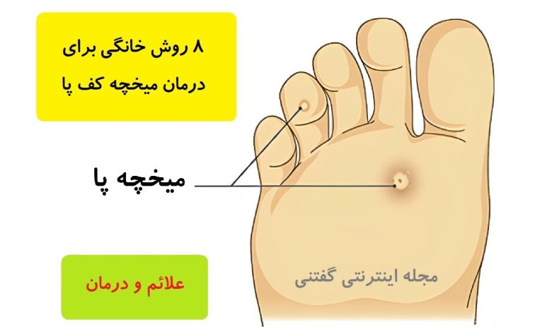 8 روش خانگی برای درمان میخچه کف پا | علائم و درمان میخچه