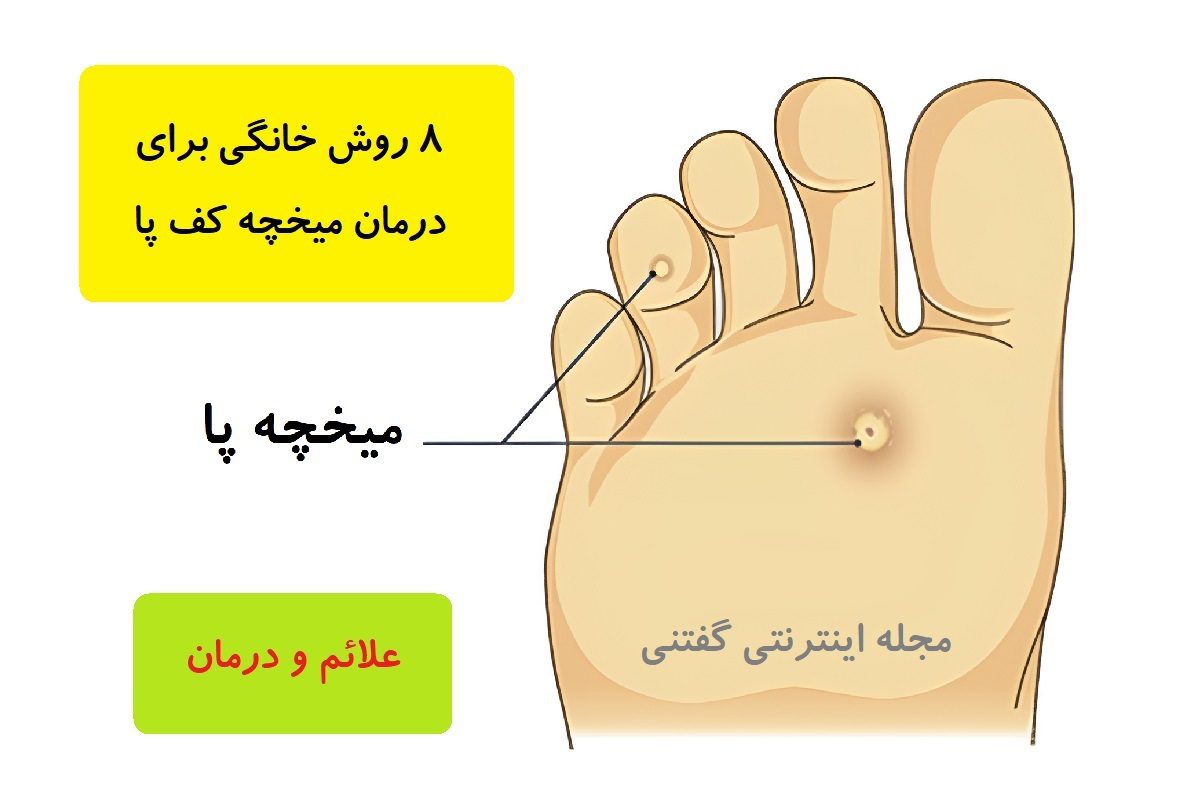 8 روش خانگی برای درمان میخچه کف پا | علائم و درمان میخچه