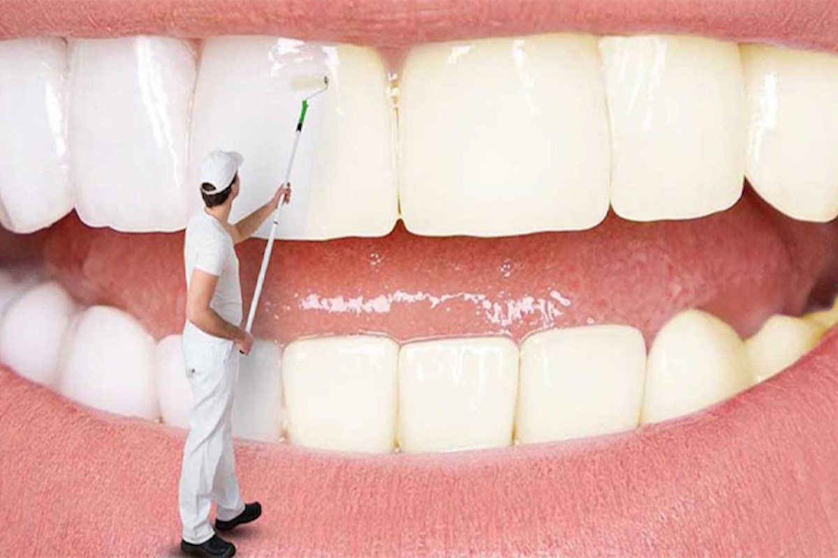 سفید کردن فوری دندان های زرد شده 2