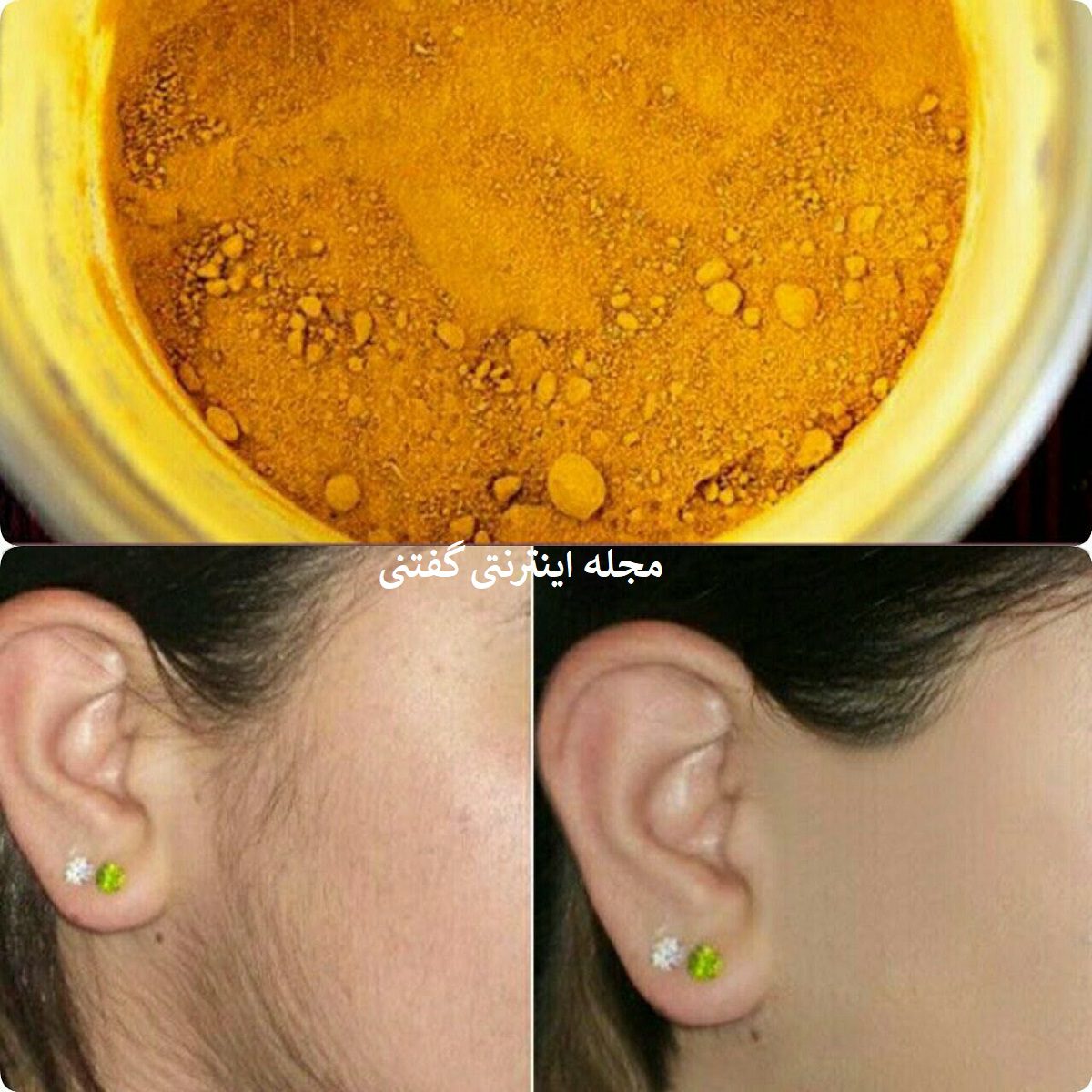 از بین بردن موهای زائد3