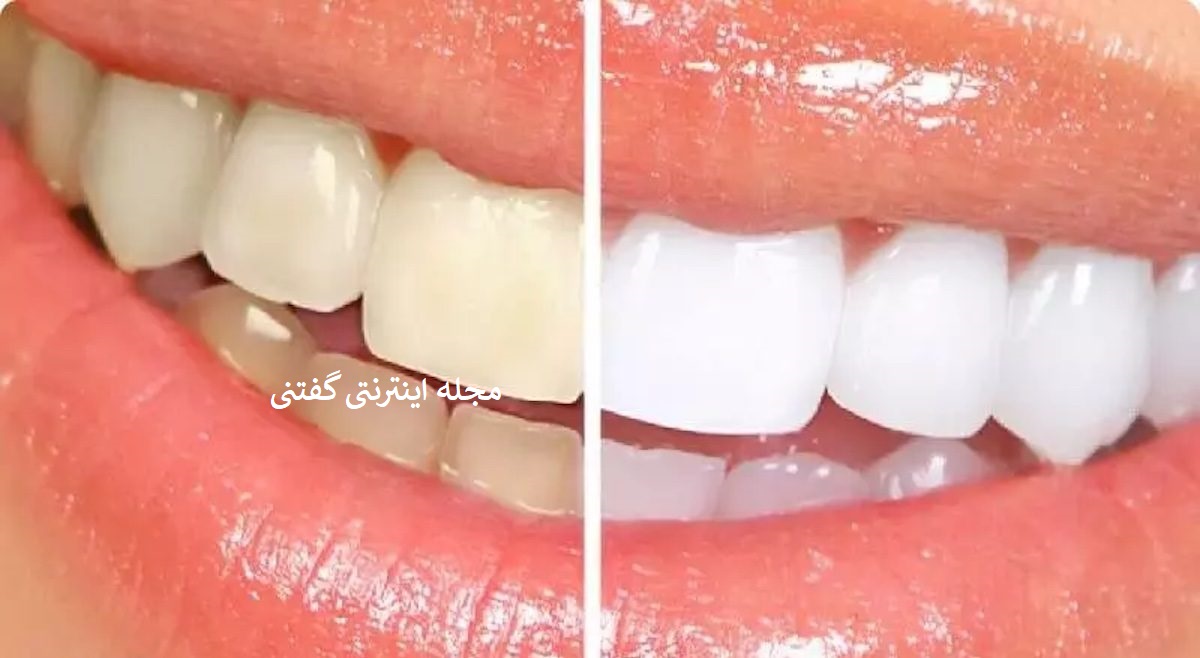 سفید کردن دندان در خانه1