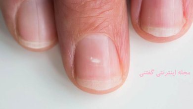 علت لکه های سفید روی ناخن