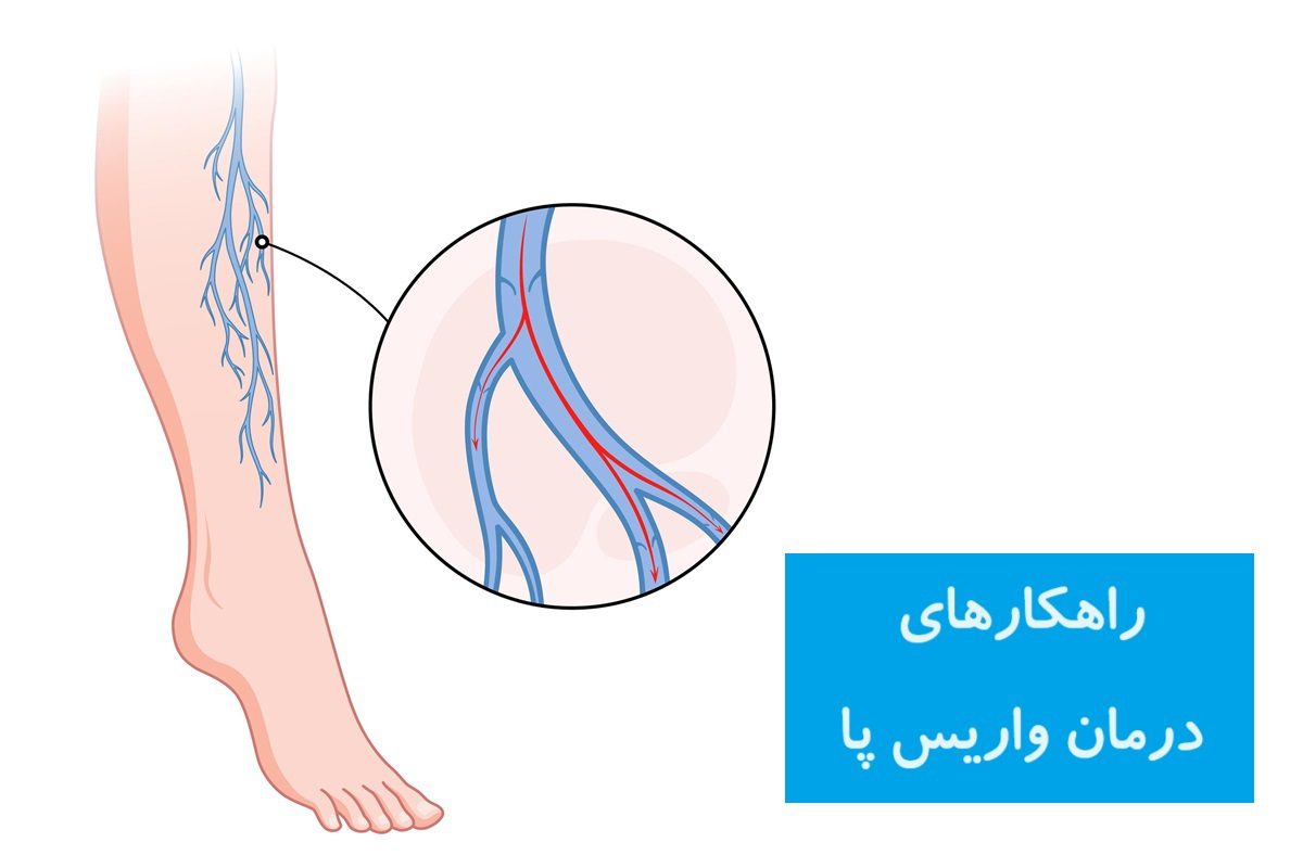 درمان واریس پا