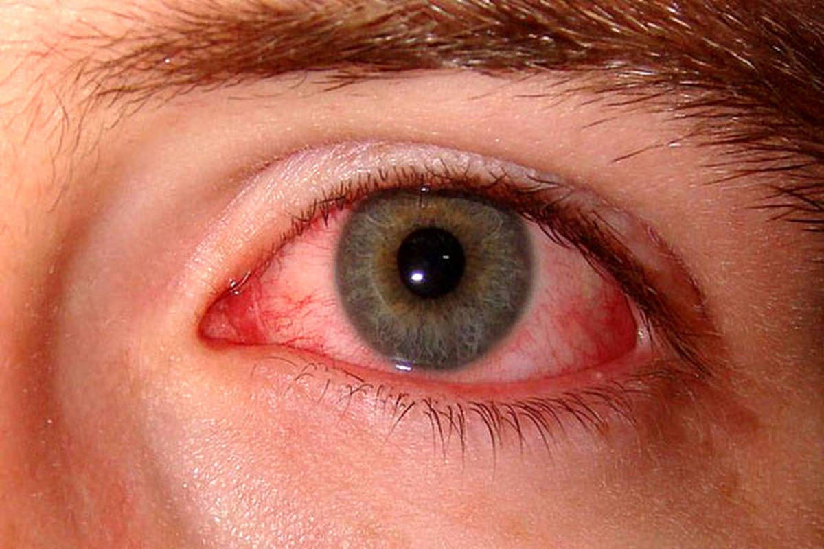 درمان خشکی چشم 2