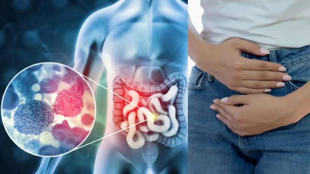 اجتناب از غذاهایی که عامل سرطان روده هستند-1