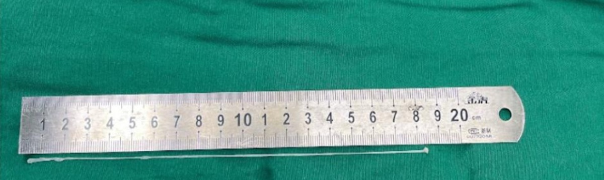 پزشکان کرم زنده را از مغز بیمار چینی بیرون آوردند-1