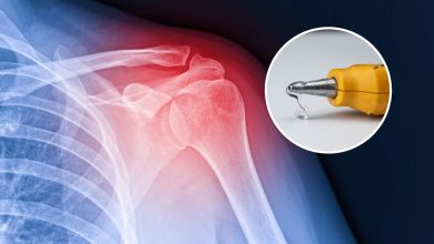 چسبی که استخوان‌های شکسته را ترمیم می‌کند