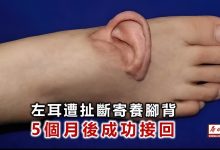 جراحی موفق گوش قطع‌شده‌ زن چینی-1